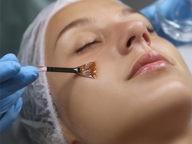 Peeling químico